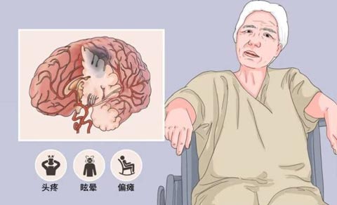 國(guó)內(nèi)已有5款新藥IND獲批，干細(xì)胞治療腦卒中的臨床研究進(jìn)展